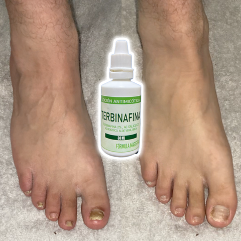 Image of Gotas de TERBINAFINA para los hongos en las uñas.